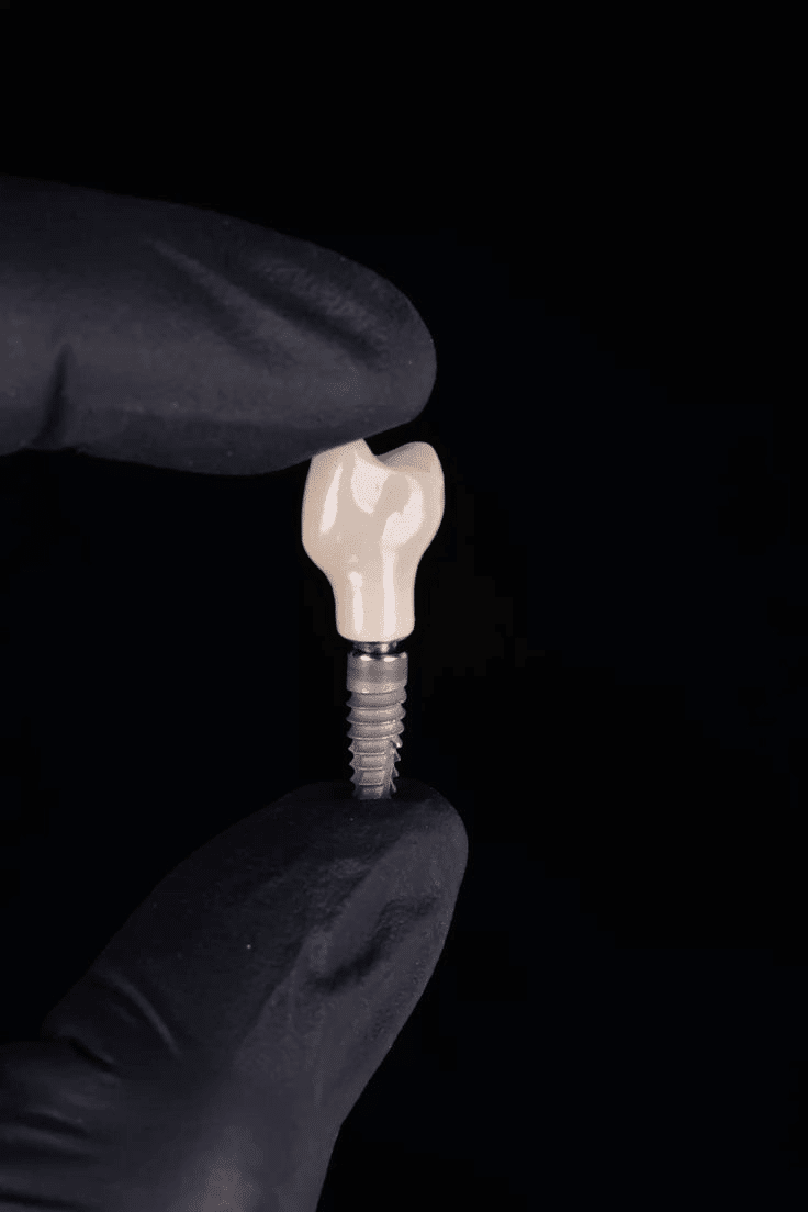 Implant dentaire