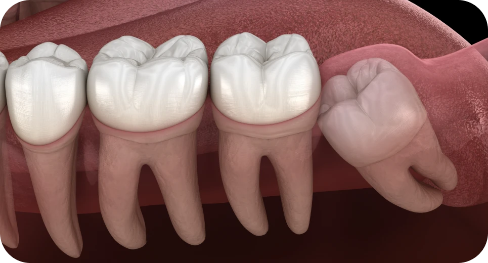 Dents de sagesse incluses avant extraction