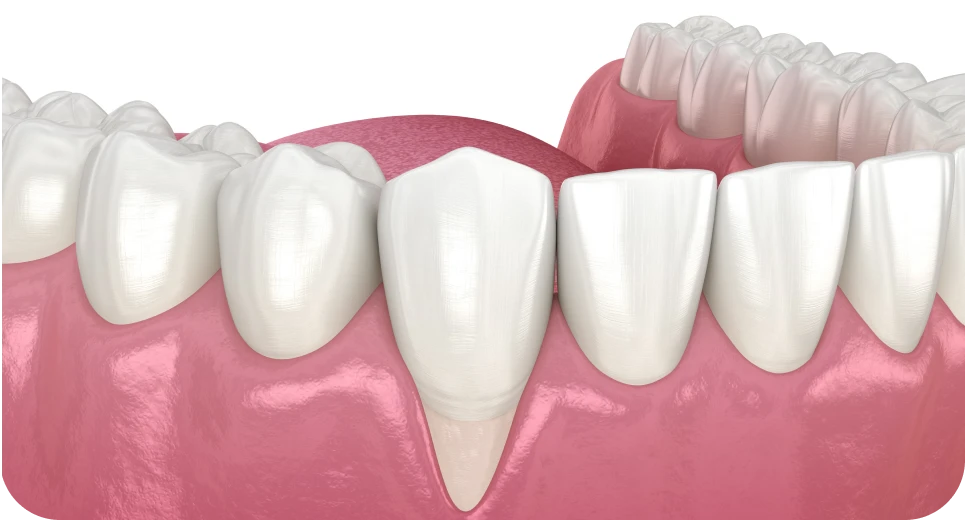 Greffe gingivale traitant une récession de la gencive