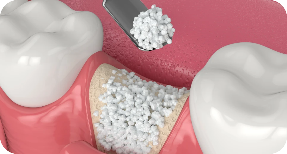 Greffe osseuse préparant la pose d'un implant