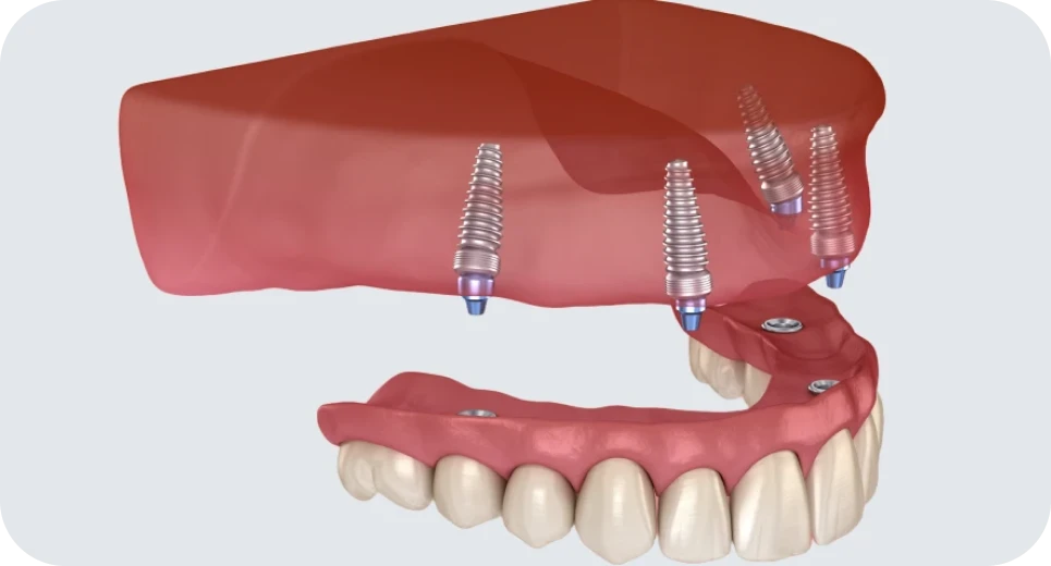 Prothèse stabilisée sur implants dentaires