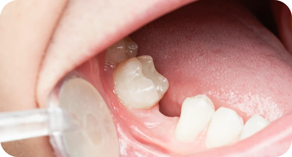 Remplacement d'une dent absente